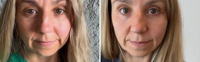 I get Botox as often as I can afford it. My aging face started to distract me on work calls — the cost is worth every penny.