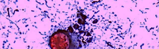 Things Are Getting Messier With the Explosive Diarrhea Parasite, as Officials Chase Down Multiple Outbreaks