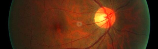 First Human Receives Experimental Therapy to Reverse Cellular Aging