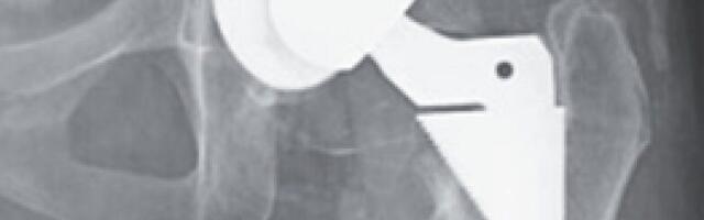 Woman's puzzling decline turns out to be cobalt poisoning from hip replacement