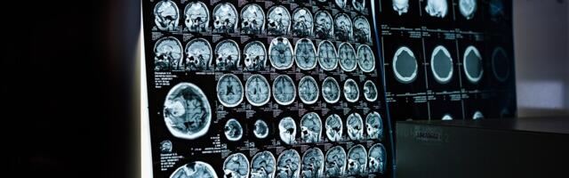 AI nearly twice as good as biopsy at assessing rare cancer