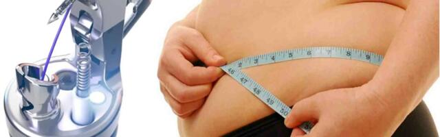 История создания Apollo OverStitch: как инженерная идея превратилась в технологию лечения ожирения