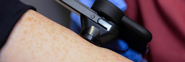 Skin Analytics raises £4M Series A to use AI for skin cancer screening