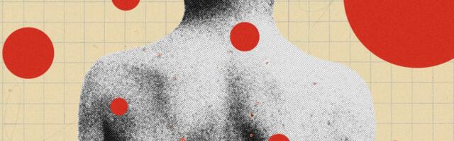 The Backward Logic of Chickenpox Parties