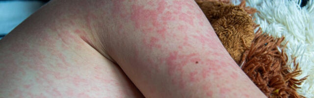 Texas measles outbreak reaches 90 cases; 9 cases in New Mexico