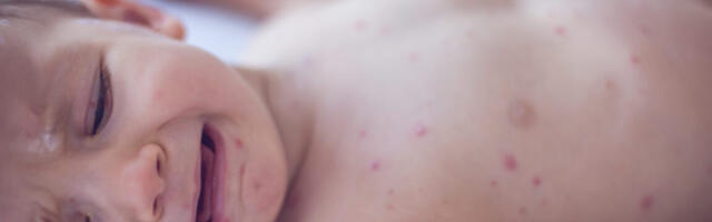 US measles outlook is so bad health experts call for updating vaccine guidance