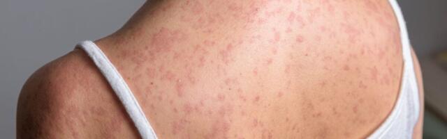 As Measles Cases Top 2,000, the U.S. Is on Brink of Losing Its Elimination Status