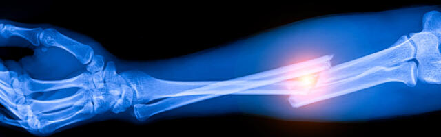 Лечение переломов: 3D-печать гидрогелевого импланта