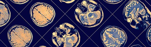 This Brain Disease Terrified Canada. A New Study Claims It Never Existed