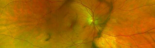 Как я не сберёг глаза и заработал деструкцию стекловидного тела (ДСТ)