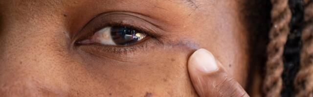 Surgeons Make History by Removing Woman’s Brain Tumor Through Her Eye