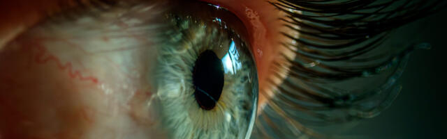 Bad sleep made woman's eyelids so floppy they flipped inside out, got stuck