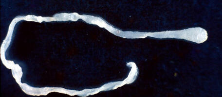 Surprised doctors find 10-inch worm in man's groin during elective surgery
