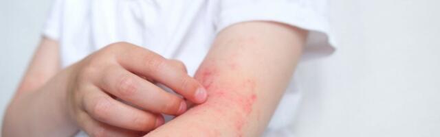 Study Says U.S. Babies Are Missing a Key Gut Microbe, Fueling Allergy Risk