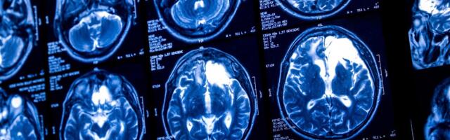 A Mad Cow-Like Prion Disease Has Killed Two People and Sickened a Third in Same Oregon Town