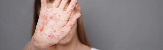 The Ongoing Measles Outbreak Has Reached a New Peak