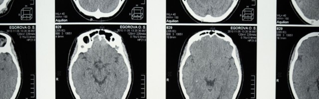 Cambridge scientists say new AI tool could diagnose dementia from a single brain scan