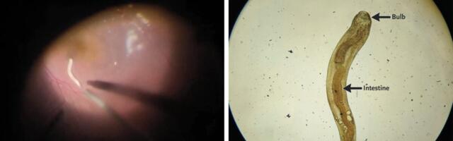 A Man’s Eye Got Infested by a Worm, so Doctors Vacuumed Out the Eye Juices