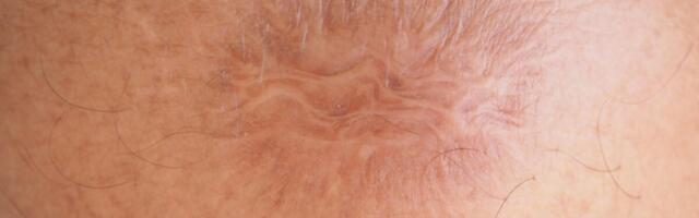 Experimental Cream Could Make ‘Permanent’ Scars a Thing of the Past