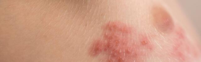 Shingles Shots Don’t Just Prevent Pain—They Might Save Your Life
