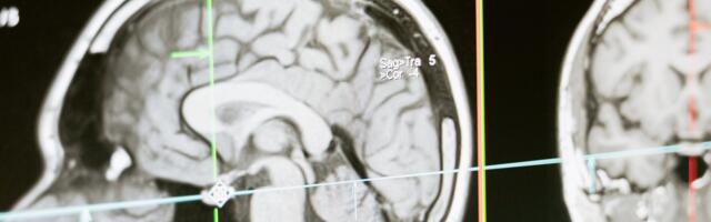 Stanford’s Successful Brain Implant Restores Function For Head Injury Patients