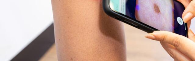 Skin Analytics raises  £15M Series B to build a future where nobody dies of skin cancer 