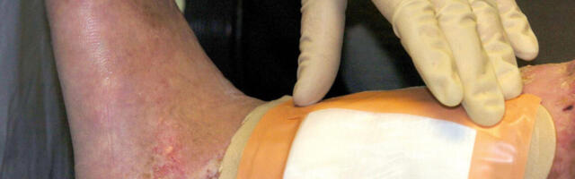 Second carcass-eating fly species cleared by FDA for maggot wound therapy