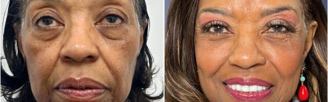 I paid $102,000 for a facelift at 71. I wish I could have done it a decade ago, but I couldn't afford it.