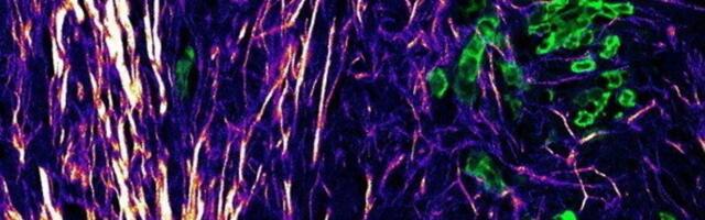 ‘Road map’ outlining how cancers spread offers hope for new treatments