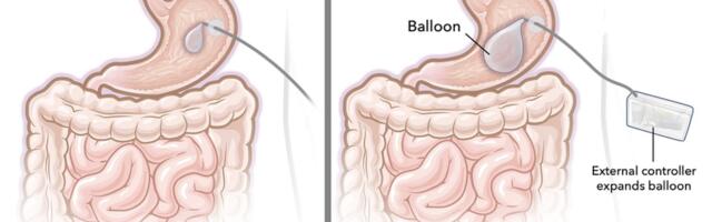 Ozempic Not Working for You? A Stomach Balloon Is the Latest Hope for W