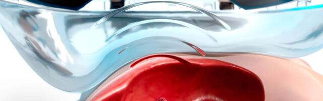Using SOUND to Fight Cancer: Doctor Explains Histotripsy video