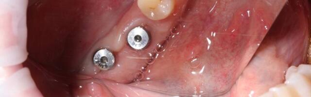 Что происходит с имплантатом в первые 3 секунды после установки