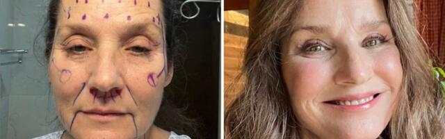 Against people's advice, I traveled to Mexico for a facelift. They assumed it was risky, but it turned out to be great.