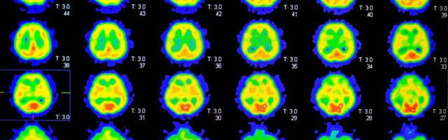 Knowing Your Alzheimer’s Risk Might Change Your Habits—and Not for the Better