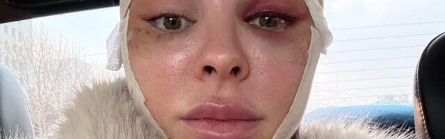 I traveled from the US to South Korea to get a facelift at 34. It boosted my confidence.