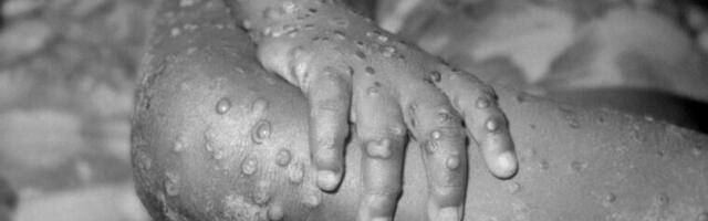 New mpox outbreak raises alarm; WHO considers declaring international emergency