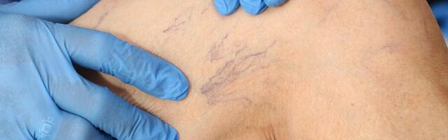 Chronic Venous Insufficiency: A Vein Specialist on Causes and Symptoms for Trump's Diagnosis