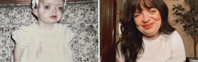 I spent years trying to hide my face. Today, I'm a proud woman who embraces my facial differences.