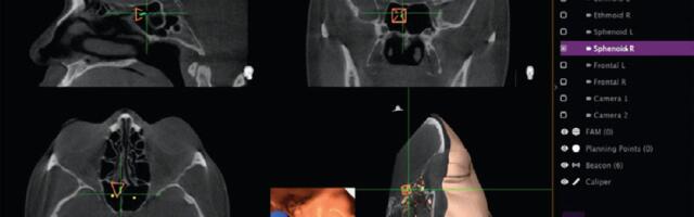 Adding AI to sinus surgery system saw malfunctions rocket from eight to 100 incidents, according to new investigation — skull-puncturing errors are the stuff of nightmares