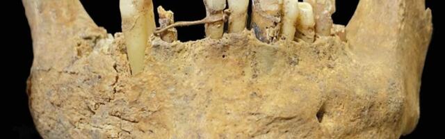 Archaeologists Unearth ‘Advanced’ Gold Dental Bridge in Medieval Scottish Grave