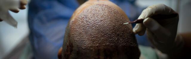 How Turkey Hacked the Hair Transplant Industry