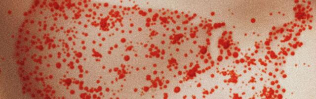 Scientists Find Measles Likely To Become Endemic in the US Over Next 20 Years