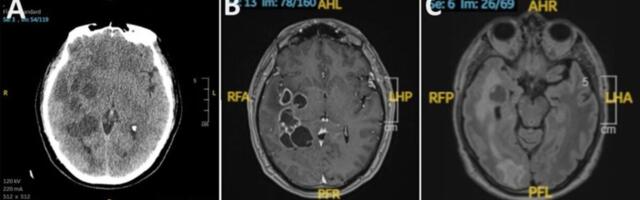 Man’s Suspected Brain Cancer Turns Out to Be Something Much Creepier