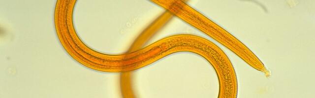 Man’s health crashes after getting donated kidney—it was riddled with worms