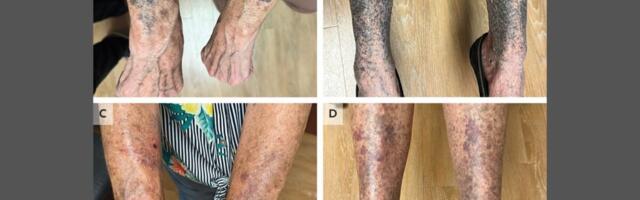 Antibiotics Turned This Woman’s Limbs Into an Unsettling Horrorshow