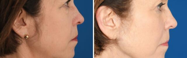 I've spent $33,000 on cosmetic procedures at 65. It's been life-changing for my career and confidence.